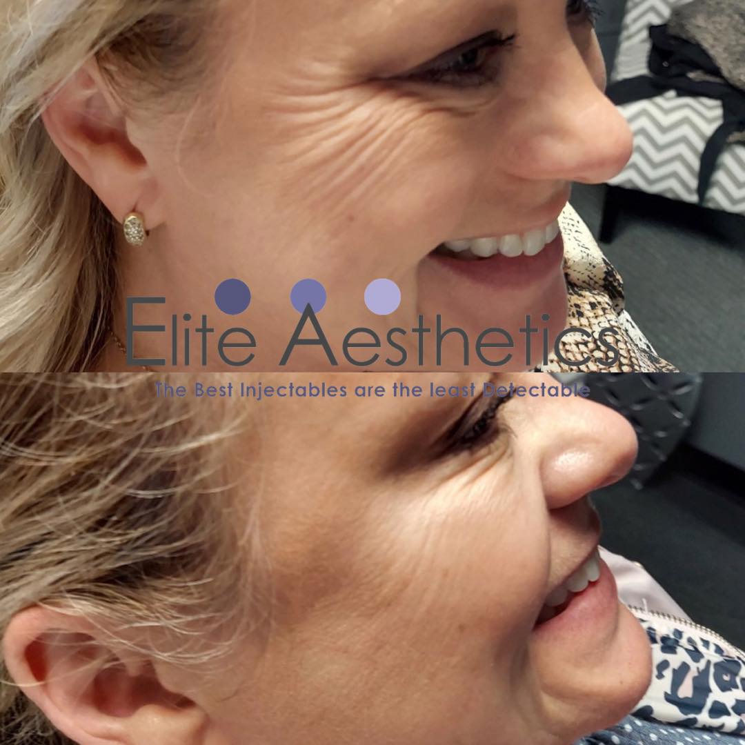 Microneedling Overland Park Kansas